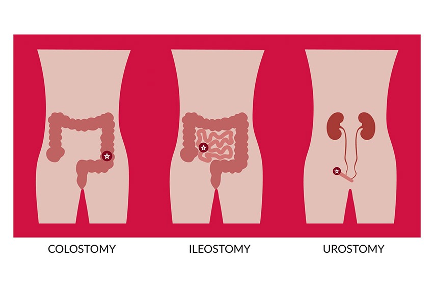 Types of Ostomies | Rory Hornstein | Registered Dietitian | Calgary and Surrounding Areas